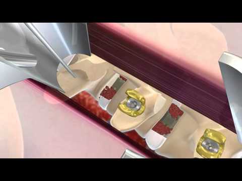 QUADRANT with TLIF sml | Transforaminal Lumbar Interbody Fusion