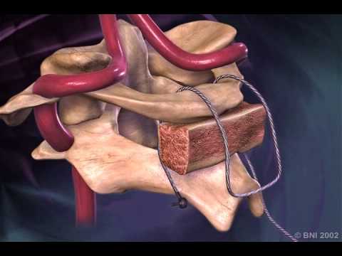 AN2 C1C2 Posterior Graft Fixation - Dr Manish Vaish